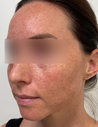 Sculptra — Skin Firmness - Before